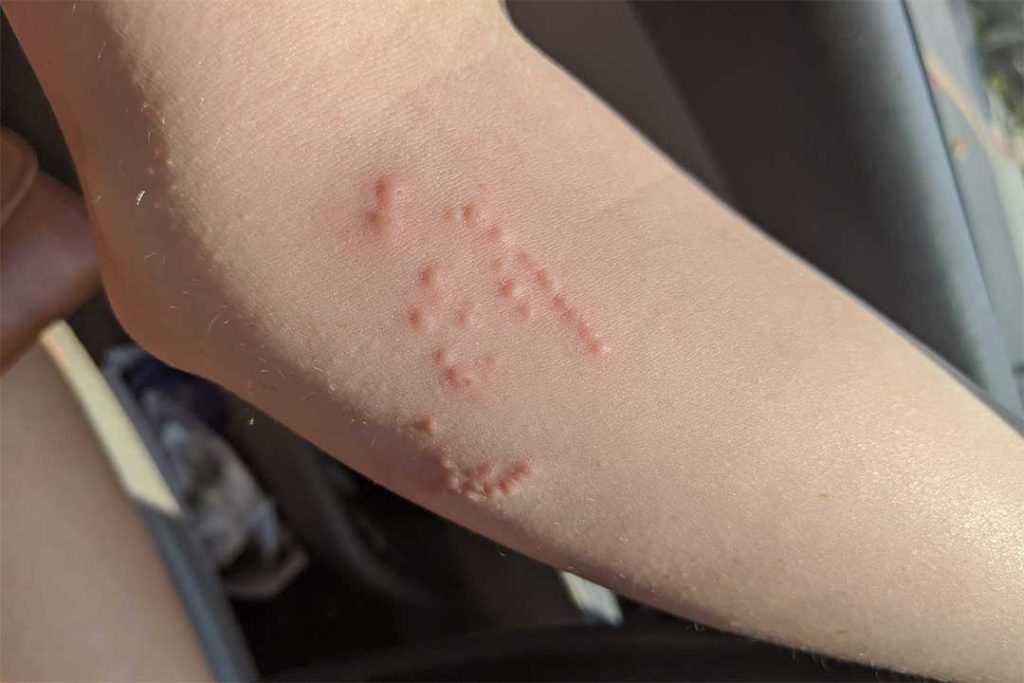 allergic reaction to a snake bite bacterias